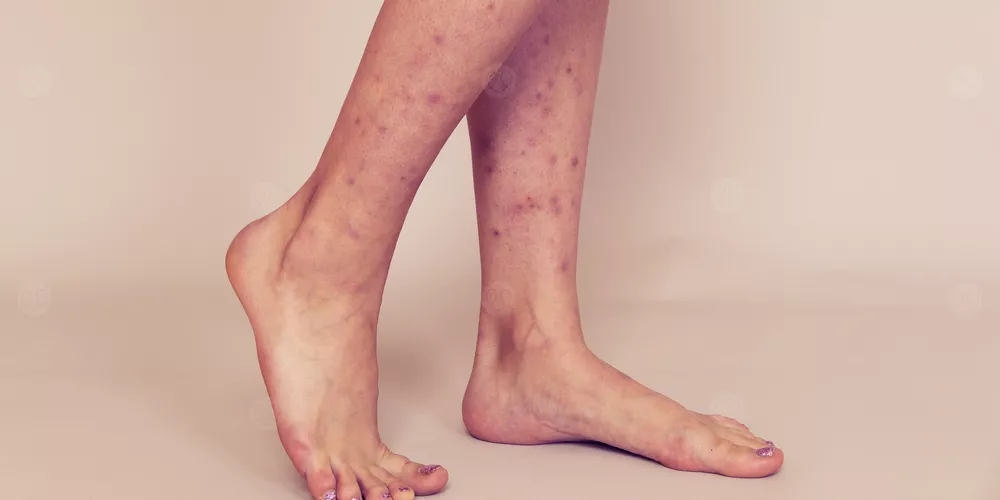علاج البقع البنية في الساقين