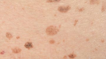 أسباب ظهور بقع بنية على الظهر والصدر