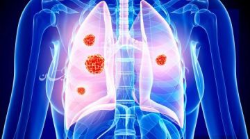 حالات شفيت من سرطان الرئة المرحلة الرابعة