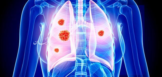 حالات شفيت من سرطان الرئة المرحلة الرابعة