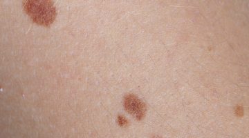 بقع بنية على الجلد بدون حكة