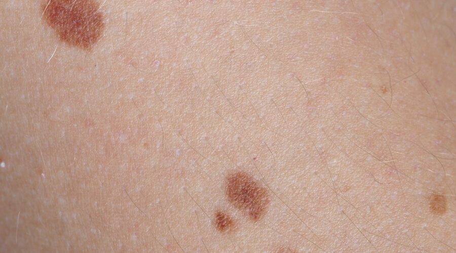 بقع بنية على الجلد بدون حكة