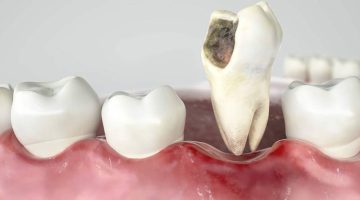 تفسير حلم خلع الضرس المسوس باليد