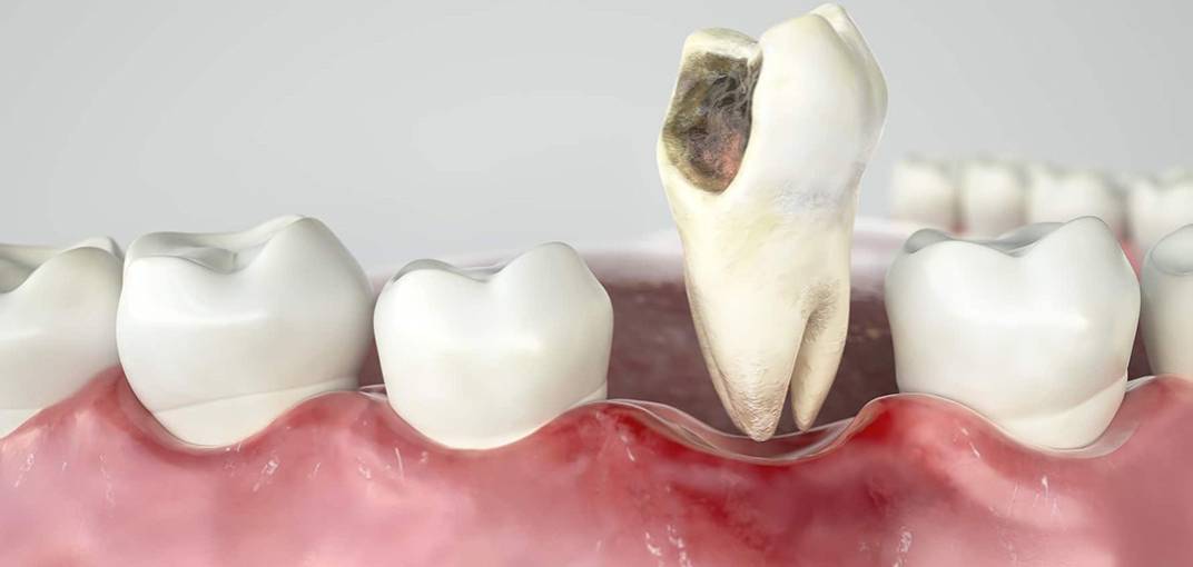 تفسير حلم خلع الضرس المسوس باليد