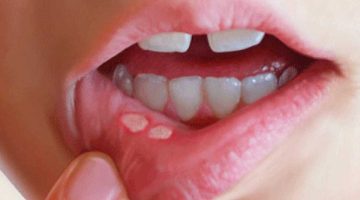 مدة علاج الهربس عند الأطفال