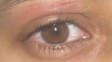 مرهم لعلاج تورم جفن العين العلوي