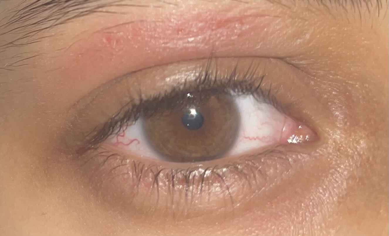 مرهم لعلاج تورم جفن العين العلوي