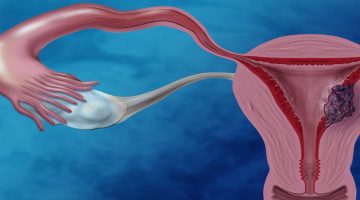 هل سرطان عنق الرحم مميت