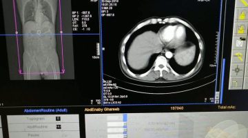 هل يجب الصيام قبل أشعة الصبغة للرحم