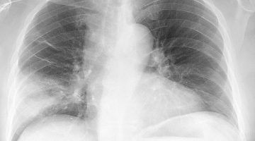 هل التهاب الرئة خطير