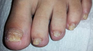 علاج فطريات الأظافر بالخل