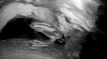 متى يظهر الحمل بتوأم في كيس واحد بالسونار