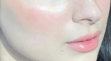 كريم لإزالة حروق الشمس من الوجه