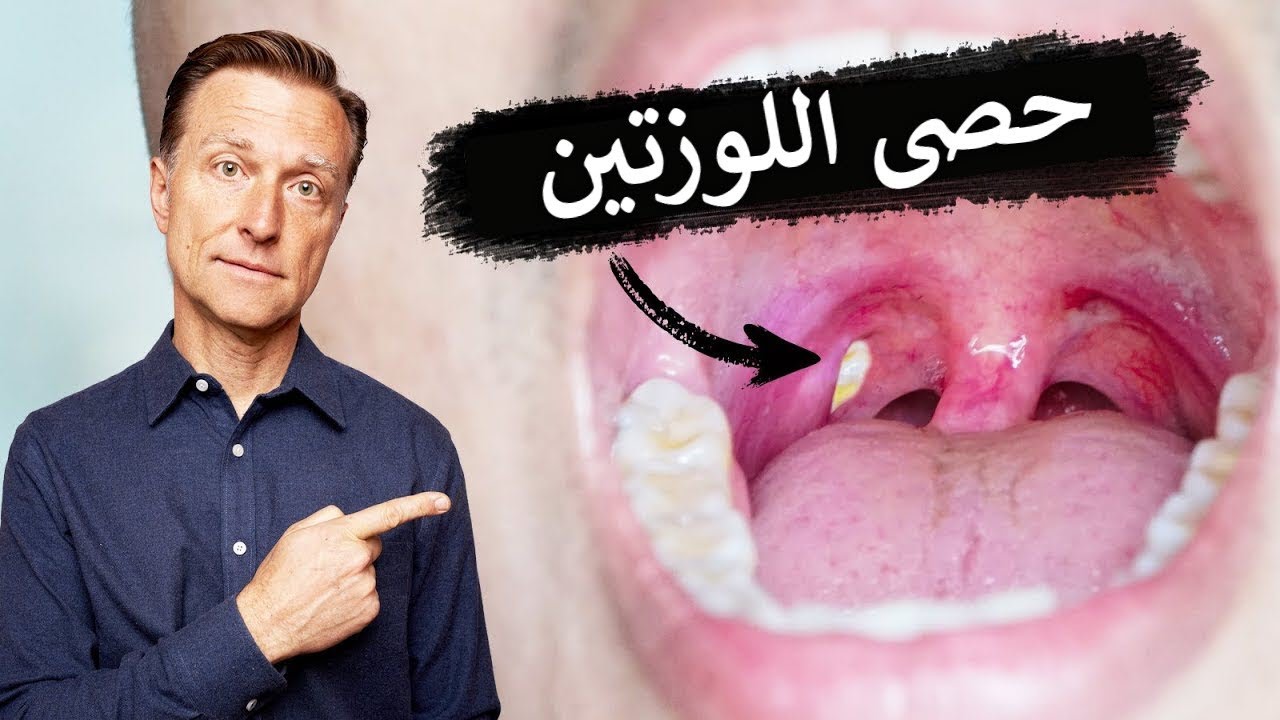 تجربتي مع حصوات اللوز