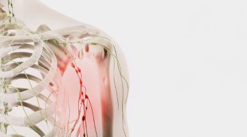 انتفاخ تحت الإبط الأيمن بدون ألم