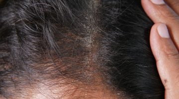 تجربتي مع فطريات الشعر