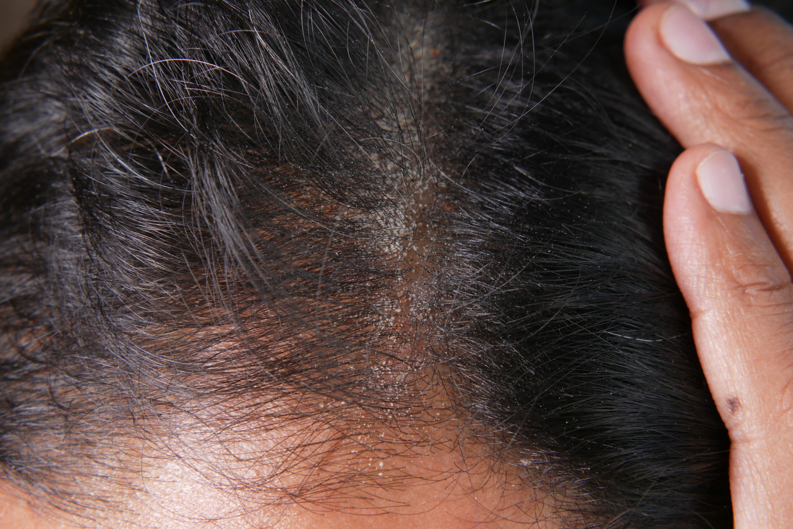 تجربتي مع فطريات الشعر