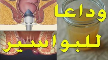 علامات الشفاء من البواسير الداخلية