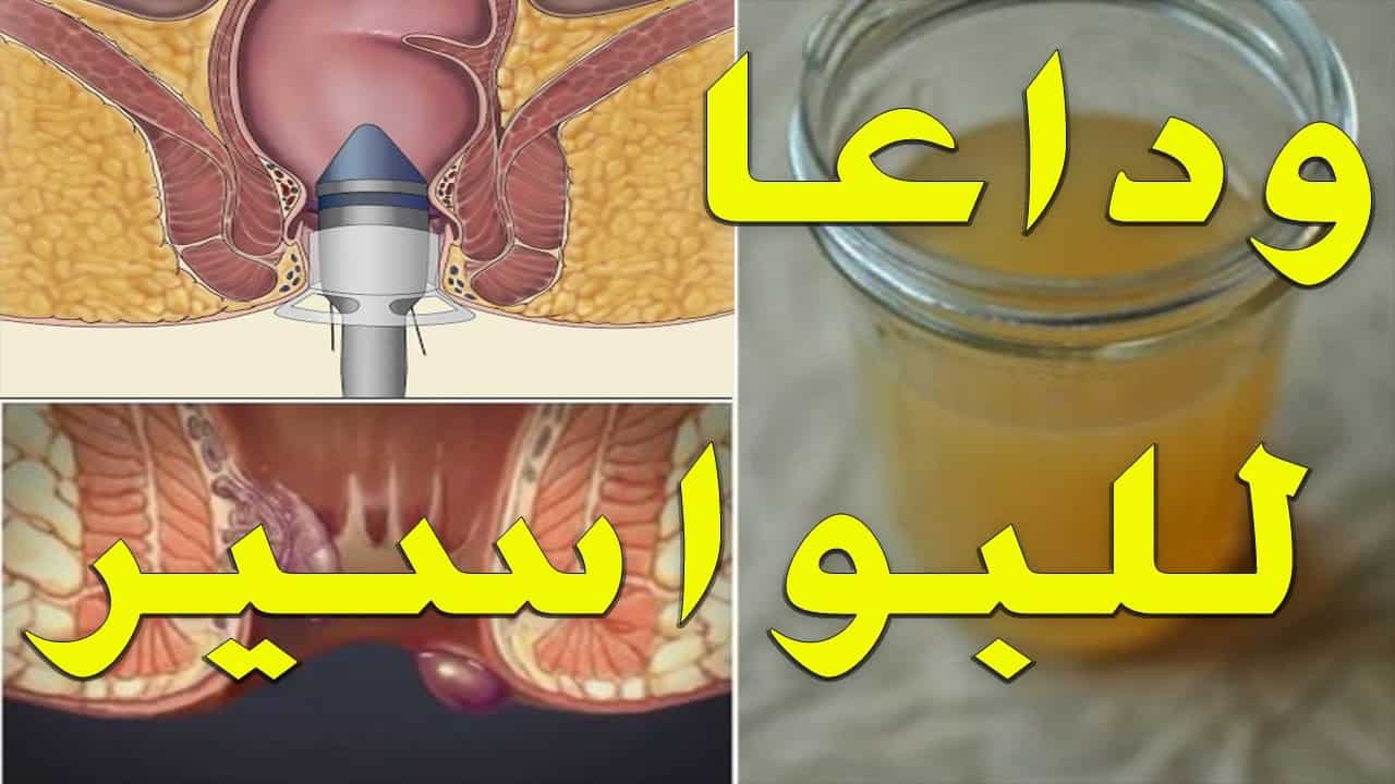 علامات الشفاء من البواسير الداخلية
