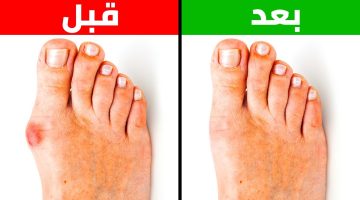 أسباب تغير لون إصبع القدم الكبير