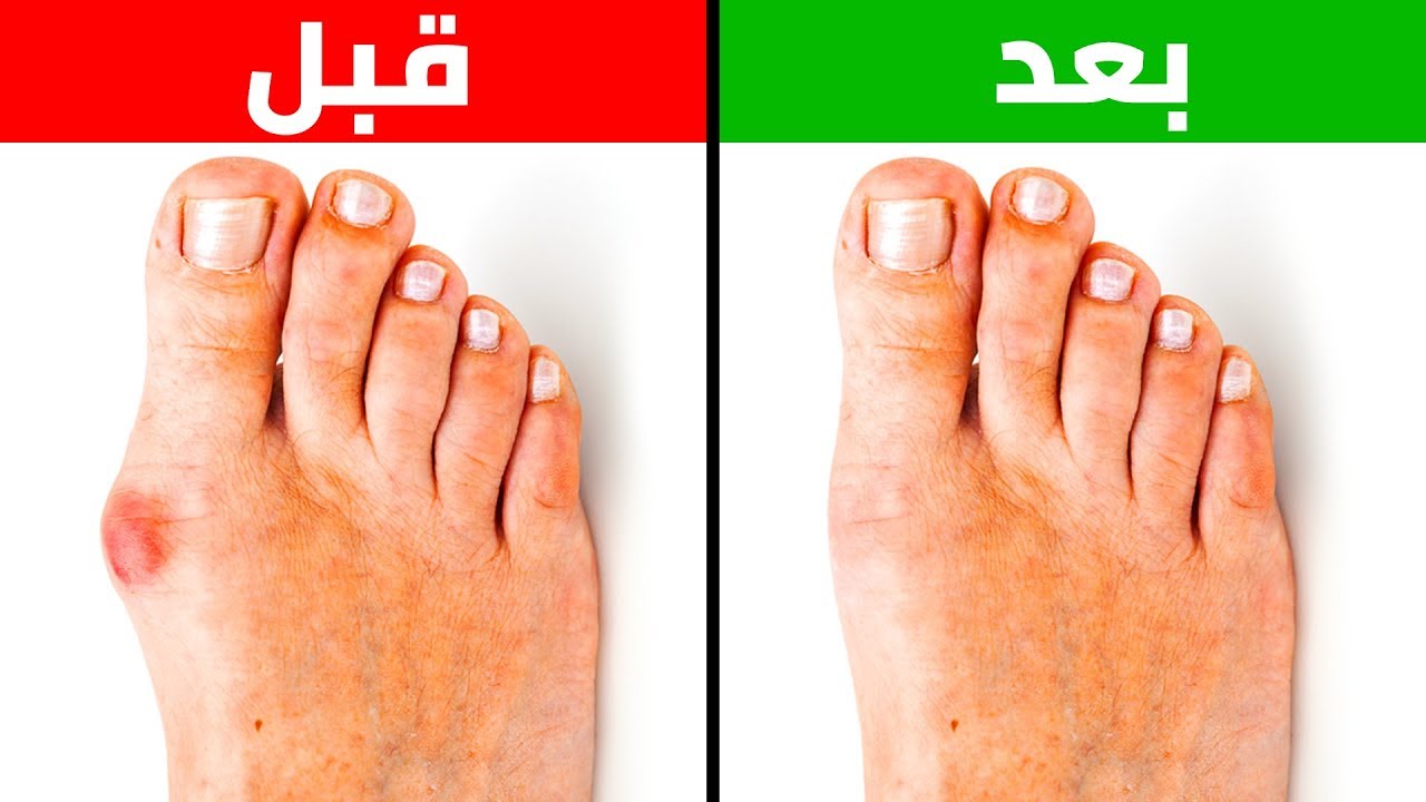 أسباب تغير لون إصبع القدم الكبير