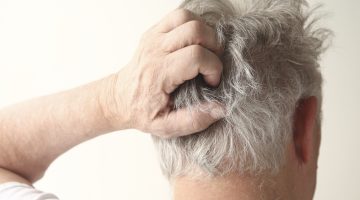 جل لعلاج صدفية الشعر