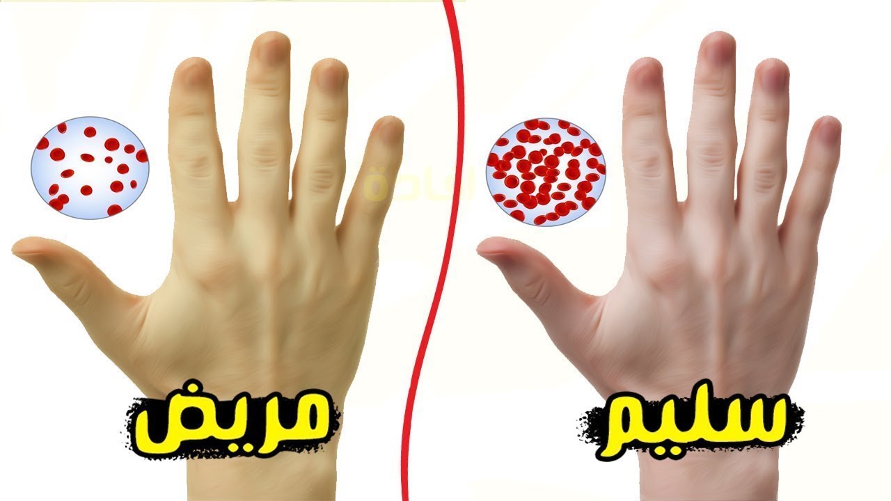 أعراض زيادة الحديد في الجسم