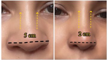 تجميل الأنف بدون جراحة