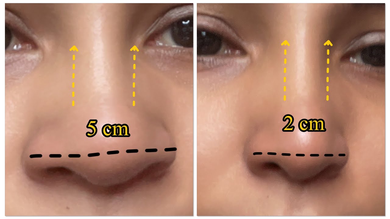 تجميل الأنف بدون جراحة