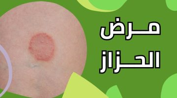 هل الحزاز مرض خطير