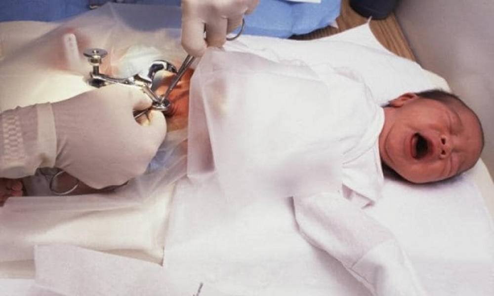 شكل الختان الصحيح للذكور