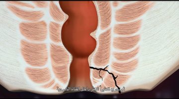 أسباب فشل عملية الناسور