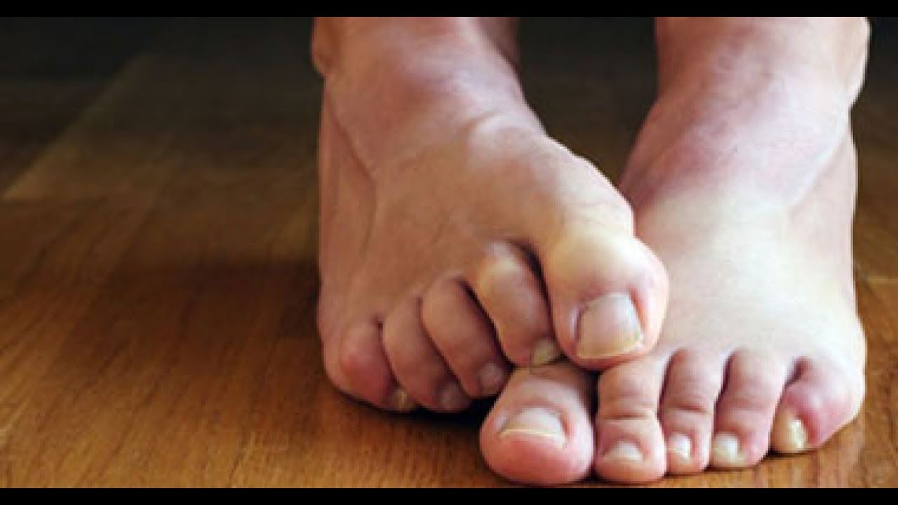 هل حرارة القدمين من علامات العين