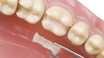 حشوة أسنان تباع في الصيدلية