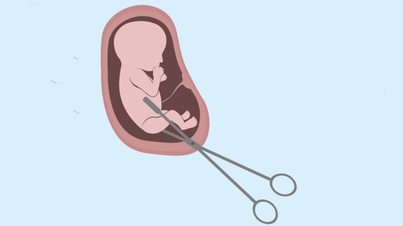 تجربتي مع الإجهاض في البيت