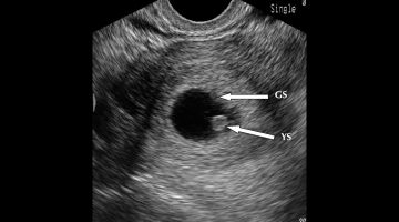 طريقة الفلبينيات لمعرفة نوع الجنين