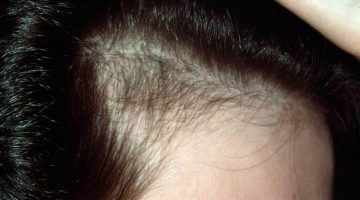 أسباب تساقط الشعر عند الشباب