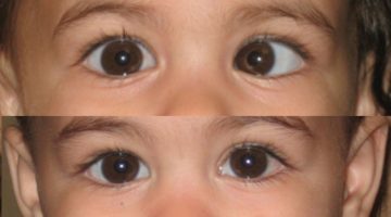 الفرق بين الحول والحور في العين