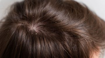 القمل في الحلم للبنت