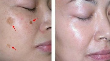 طرق إزالة البقع من الوجه في يومين