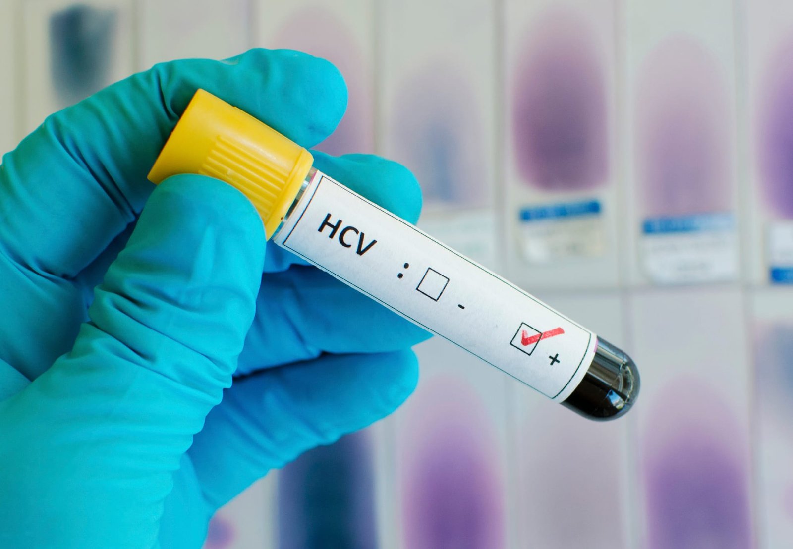 سعر تحليل الكبد الوبائي في السعودية 