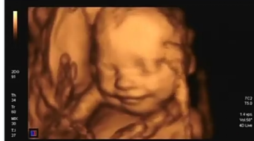 تجمع الجنين في جهة اليسار في الشهر التاسع