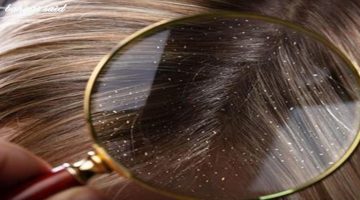 علاج قشرة الشعر الجاف