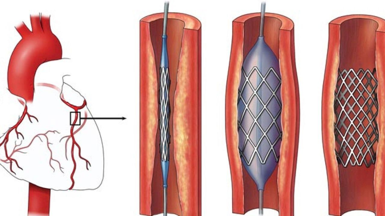 الآثار الجانبية بعد عملية القسطرة