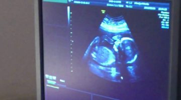 حلمت اني عملت سونار وطلعت حامل ببنت للحامل 