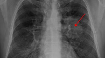 هل يشفى مريض سرطان الرئة