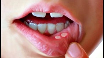 علاج كثرة اللعاب في الفم بالأعشاب