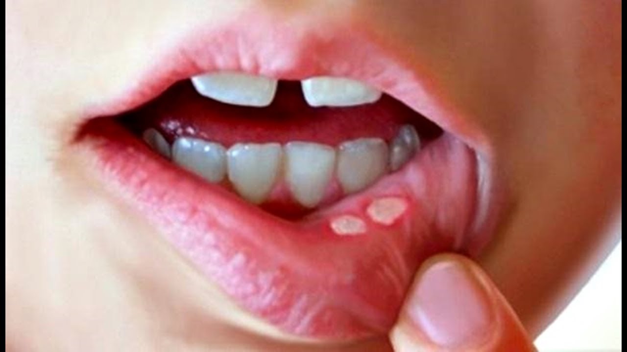 علاج كثرة اللعاب في الفم بالأعشاب