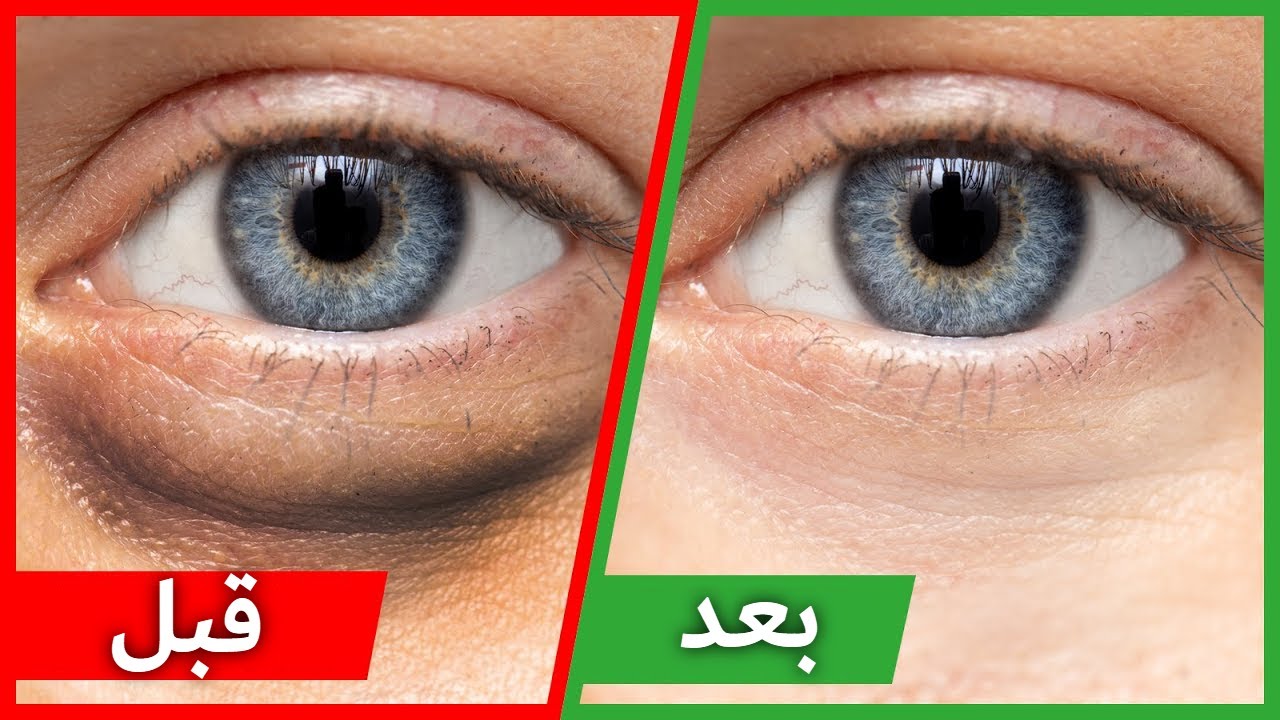 علاج الكدمات السوداء حول العين