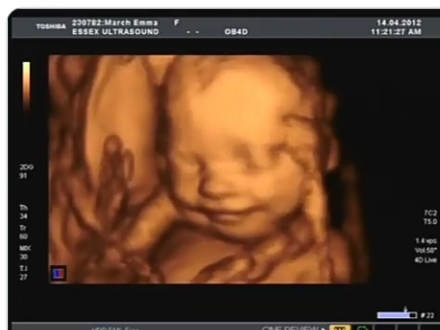 هل يختفي الماء في رأس الجنين